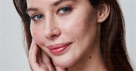 Dettaglio di una pelle con imperfezioni acneiche