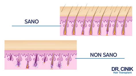Diagramma che illustra l'azione del Benzoil Perossido sui follicoli pilosebacei