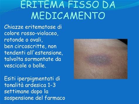 Eritema fisso da medicamento con chiazze arrossate