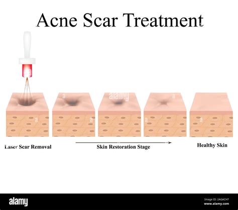 Diagram of laser acne scar treatment