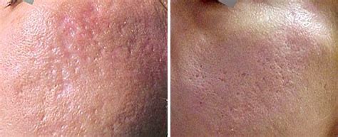 Before and after acne scar treatment with Fotona laser