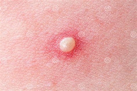 Applicazione di crema su brufolo