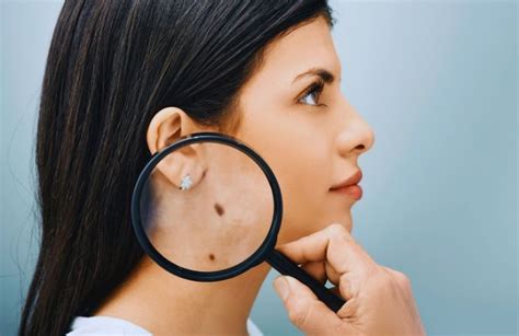 Immagine comparativa di un neo a basso e alto ingrandimento dermoscopico