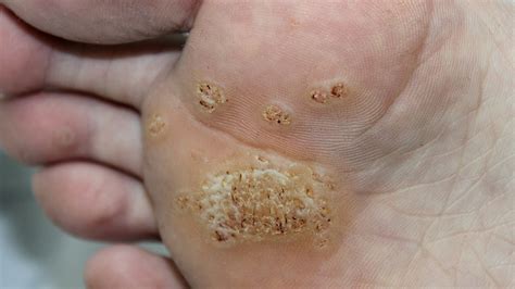 Immagine che mostra mani e piedi con verruche