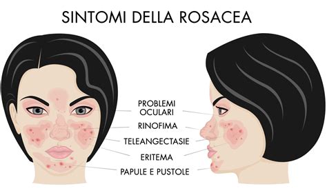 Illustrazione dei diversi sottotipi di rosacea con i relativi sintomi