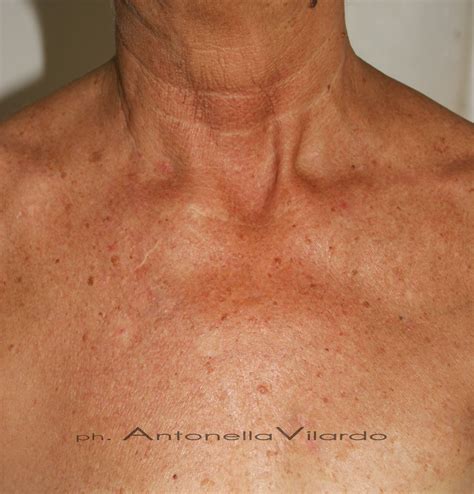 Immagine ravvicinata di cheratosi attinica