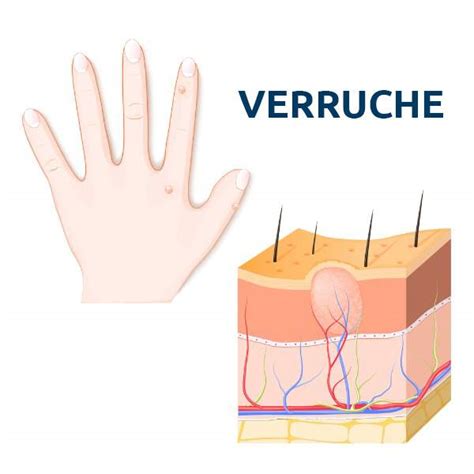 Illustrazione di diverse tipologie di verruche comuni su mani e piedi
