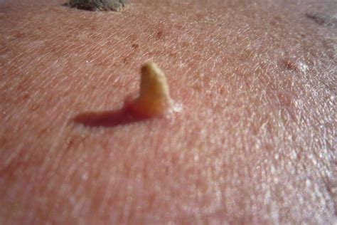 Illustrazione comparativa delle diverse tipologie di verruche: comuni, filiformi, plantari e periungueali