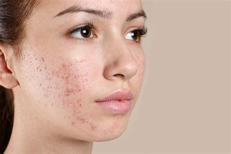 Illustrazione di un viso con acne
