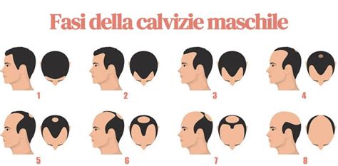 Schema delle fasi della calvizie maschile