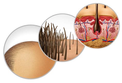 Schema delle fasi della calvizie femminile