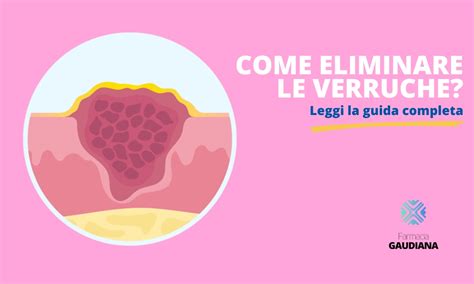 Diagramma che illustra la struttura di una verruca e il suo sviluppo nella pelle