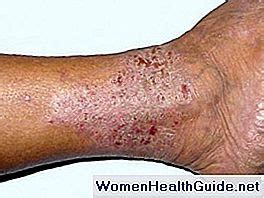 Gambe con segni di eczema da stasi