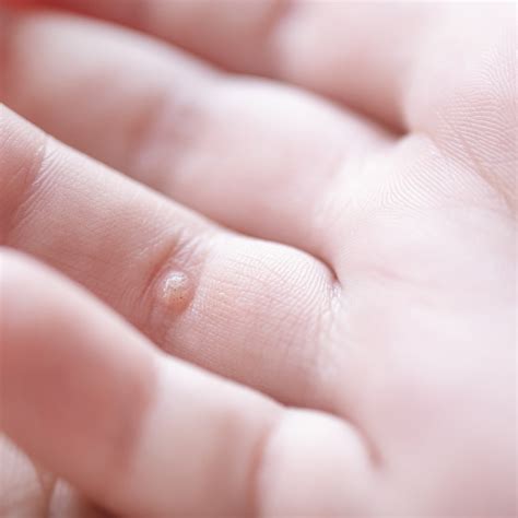 Verruche volgari sulle dita di una mano