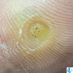 Verruca plantare con puntini neri visibili