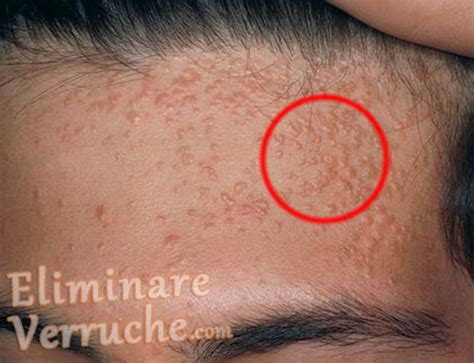 Verruca filiforme sul viso
