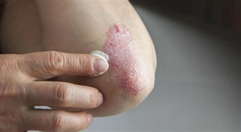 Psoriasi: placche infiammate sulla pelle