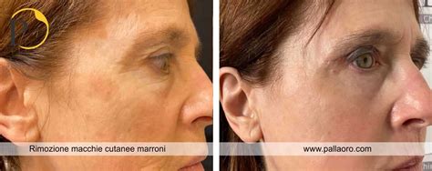 Prima e dopo: immagine che mostra la riduzione delle macchie cutanee dopo un peeling chimico