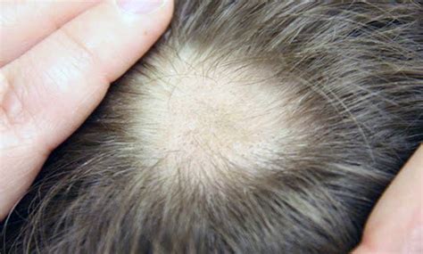 Immagine di una chiazza di alopecia areata sul cuoio capelluto