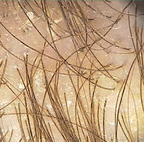 Immagine ravvicinata di squame giallastre sul cuoio capelluto