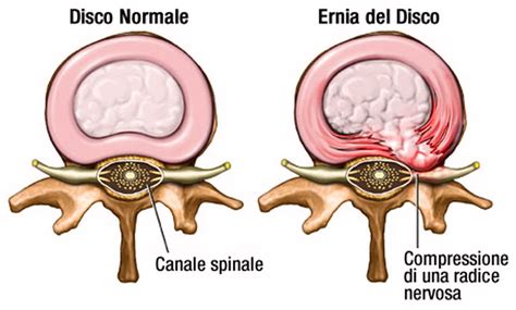 Diagramma che mostra diverse cause di compressione della cauda equina, come ernia del disco, tumore e stenosi spinale