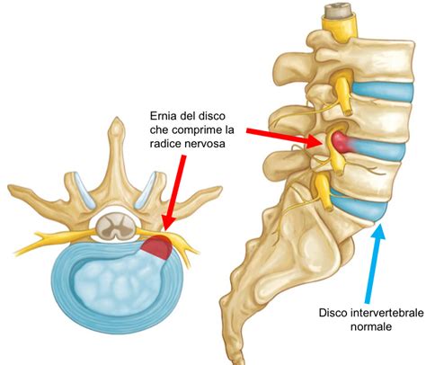Immagine RM che mostra un'ernia del disco lombare che comprime le radici della cauda equina
