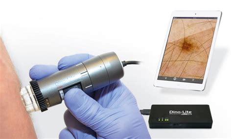 Dermatoscopio digitale in azione
