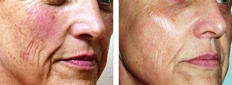 Schema del fotoringiovanimento IPL