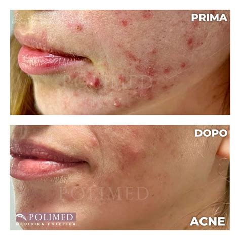 Pelle con acne prima e dopo trattamento IPL (illustrativo)