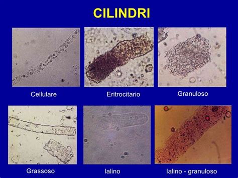 Analisi delle urine al microscopio