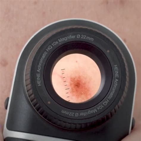 Primo piano di un dermatoscopio utilizzato per esaminare un neo