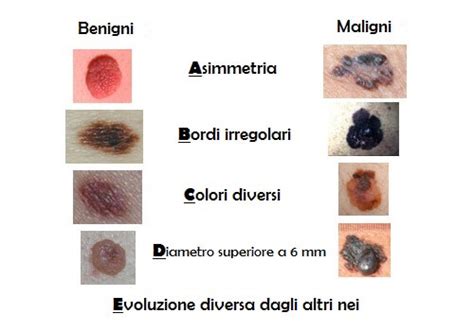 Schema che illustra la differenza tra nei normali e nei atipici (melanoma)