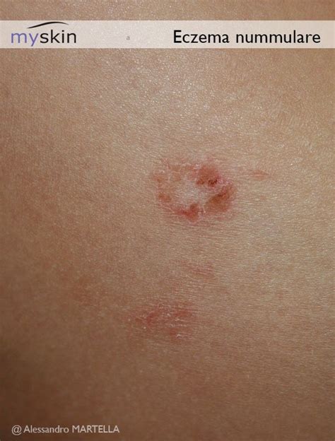 Illustrazione di chiazze di eczema nummulare a forma di moneta su pelle