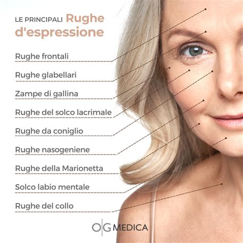 Diagramma che illustra le rughe di espressione trattate con botox