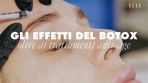 Grafico che illustra la durata media degli effetti del botox