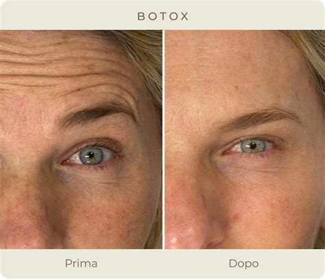 Infografica che confronta Botox e trattamenti Notox