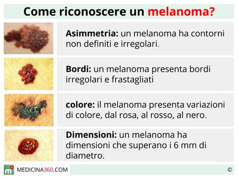 Schema dei sintomi del melanoma vulvare