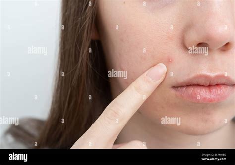 Close-up of inflamed acne pimple