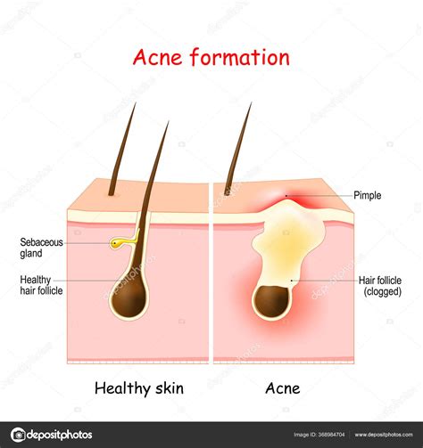 Diagramma che mostra l'ostruzione di un poro da sebo e batteri, causando acne
