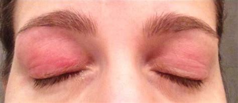 illustrazione sintomi palpebrali