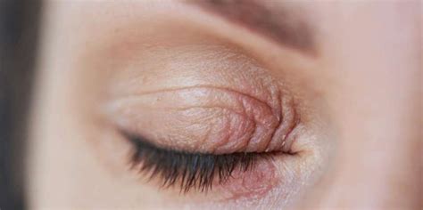 schema dermatite palpebrale