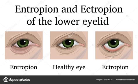 diagramma ectropion e entropion