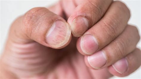 Illustrazione di unghie sane a confronto con unghie affette da psoriasi, evidenziando le differenze visive.