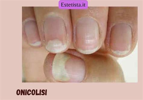 Primo piano di unghie con pitting e onicolisi per illustrare i sintomi comuni.