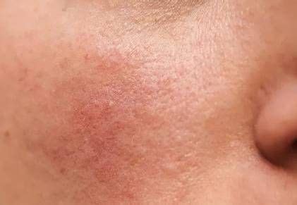 Pelle con arrossamento e secchezza tipica della dermatite atopica