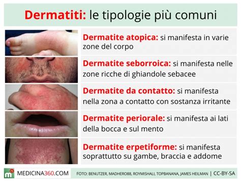 Diagramma che illustra le fasi della dermatite atopica e i sintomi associati