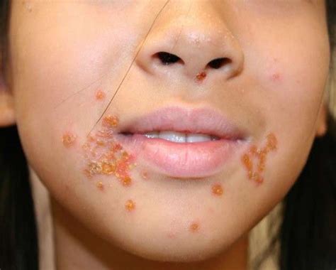 bambino con impetigine sul viso