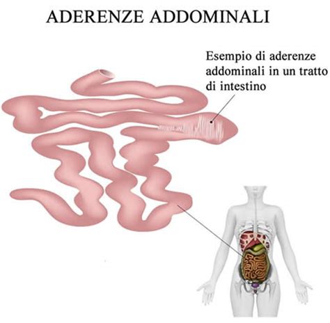 Illustrazione di aderenze addominali post-chirurgiche
