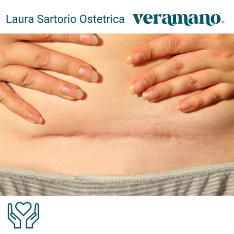 Illustrazione di una donna che esegue un automassaggio sulla cicatrice cesareo