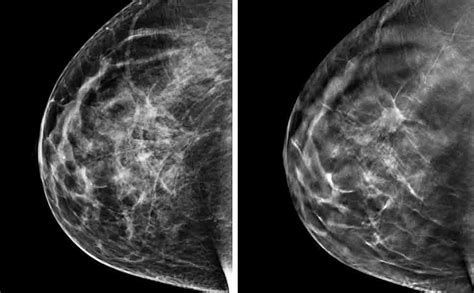 Immagine di una mammografia che mostra microcalcificazioni sospette tipiche del DCIS